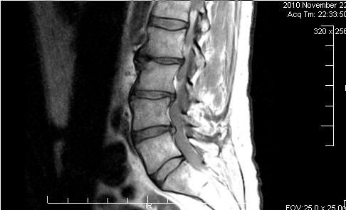 Retro listesis